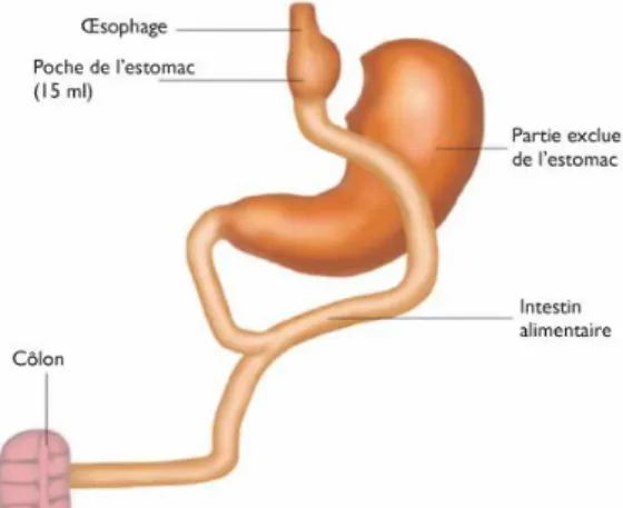 Figure 2 Roux-en-Y Gastric Bypass (10) 