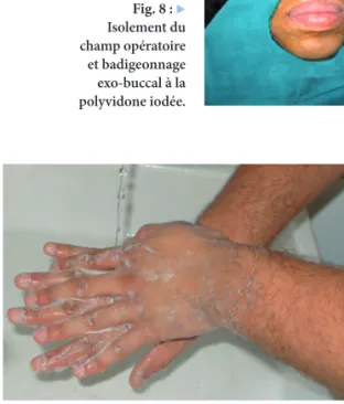 Fig. 8 :   Isolement du   champ opératoire   et badigeonnage   exo-buccal à la   polyvidone iodée.