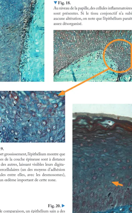 Fig. 20.   À titre de comparaison, un épithélium sain a des  cellules collées les unes aux autres au niveau de  la couche épineuse, ne montrant les digitations  intercellulaires que sous la forme de petites  épines (flèche)