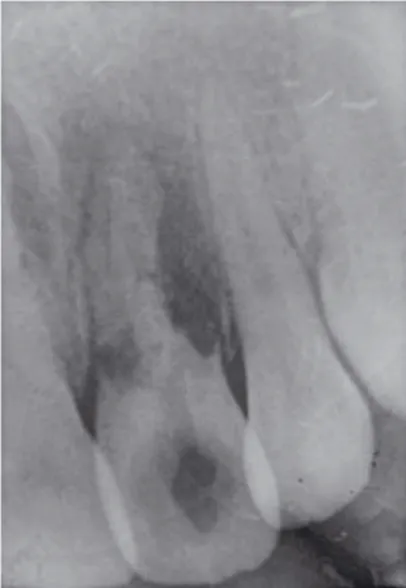 Fig. 8 :  X Dent extraite récupérée  