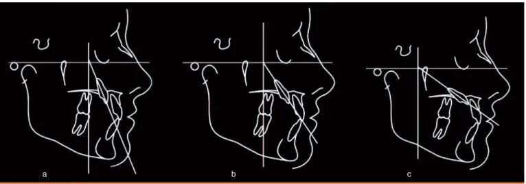 Fig. 8 Cliché  occlusal  pris  selon  l’incidence  dysocclusale  de Belot objectivant l’inclusion de la canine.