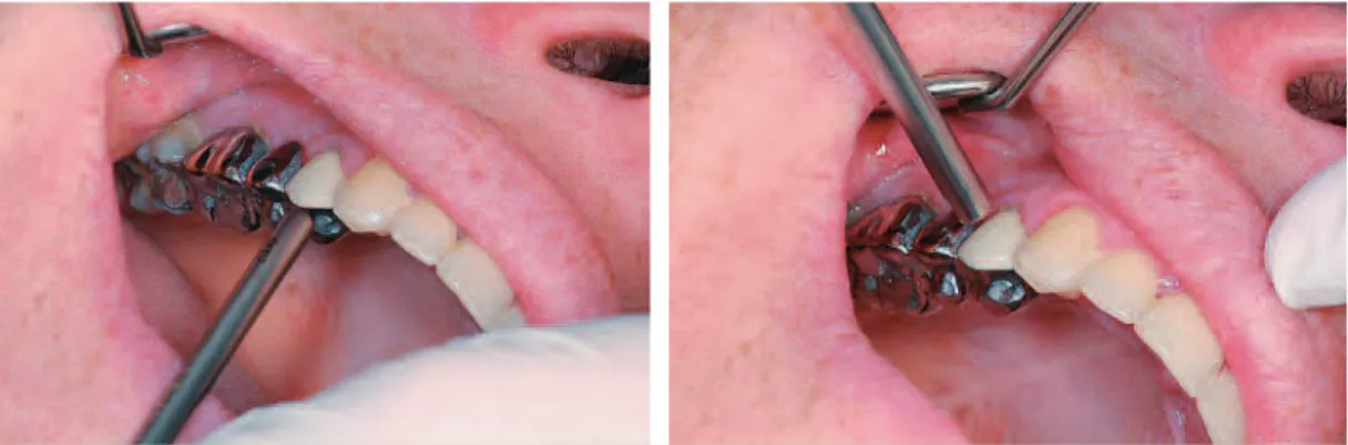 Fig. 4 Sondage parodontal.