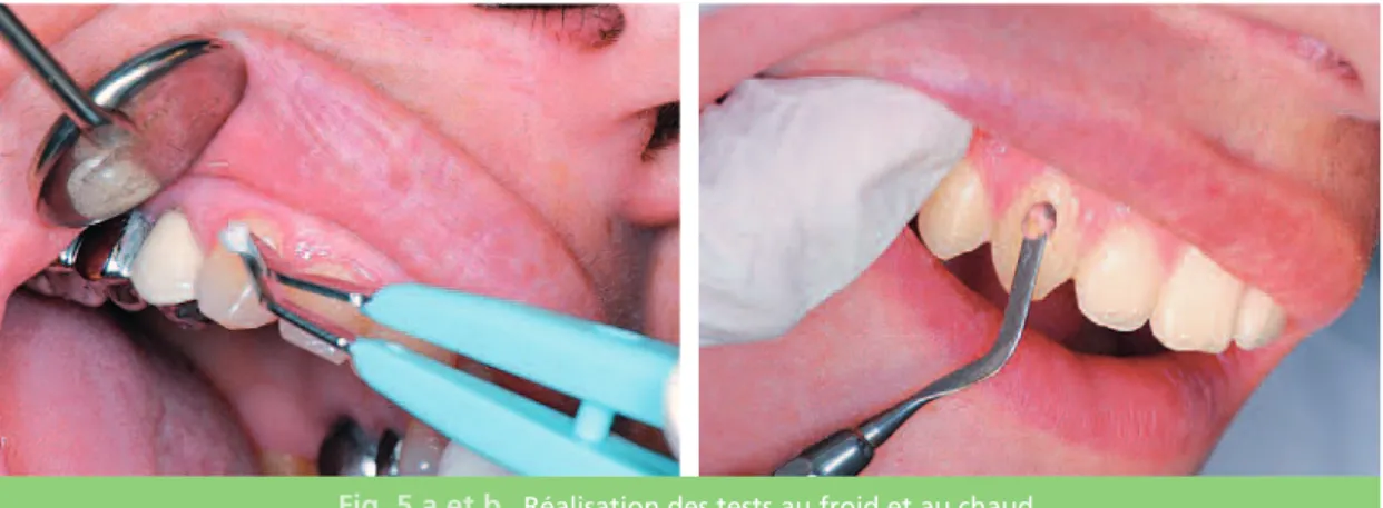 Fig. 5 a et b Réalisation des tests au froid et au chaud.
