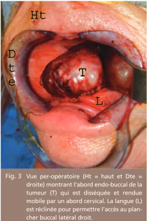 Fig. 3 Vue  per-opératoire  (Ht =  haut  et  Dte = droite) montrant l’abord endo-buccal de la tumeur  (T)  qui  est  disséquée  et  rendue mobile par un abord cervical