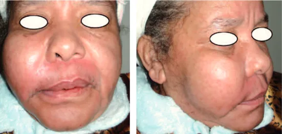 Fig. 1 a et b Photos de face et profil de la patiente montrant la tuméfaction génienne droite.
