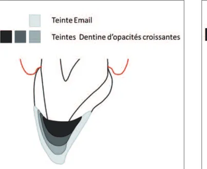 Fig. 3 Technique en 3 couches selon Vanini. Fig. 4 Technique  en  3  couches  selon  Vanini  avec  émail  de type HRI.