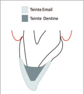 Fig. 5 Technique du « Natural Layering Concept ».
