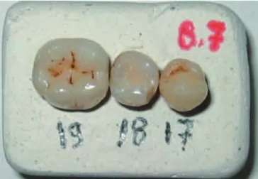 Fig. 1 Bloc de plâtre sous forme de parallélépipède compor- compor-tant 3 dents numérotées.