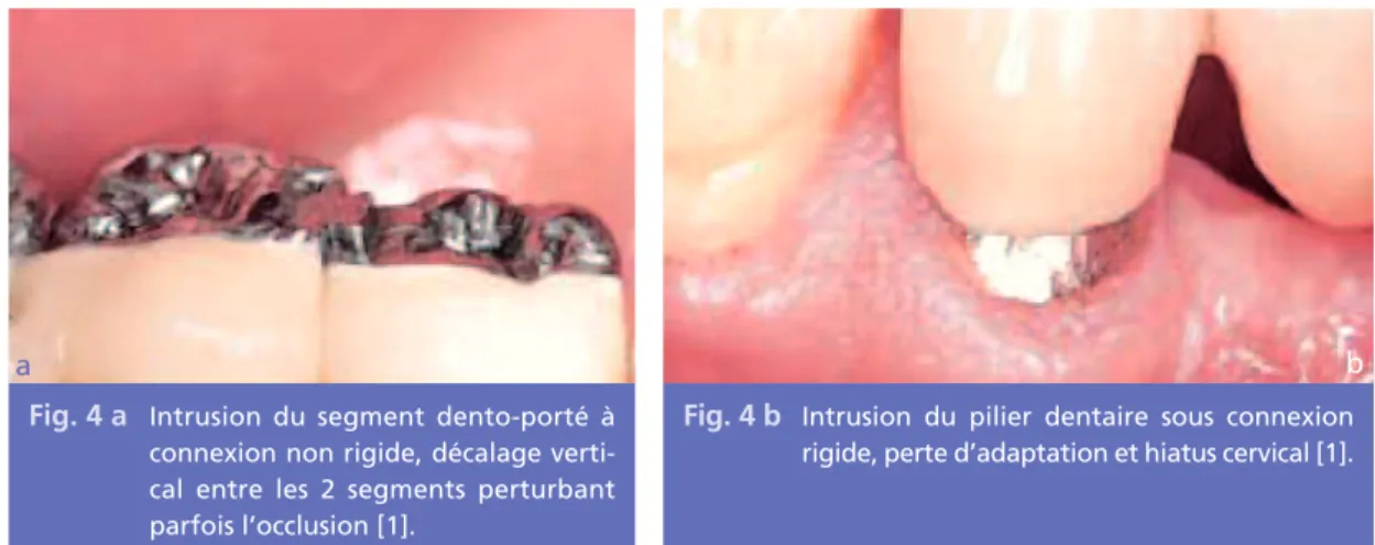 Fig. 4 a Intrusion  du  segment  dento-porté  à connexion non rigide, décalage  verti-cal  entre  les  2  segments  perturbant parfois l’occlusion [1].