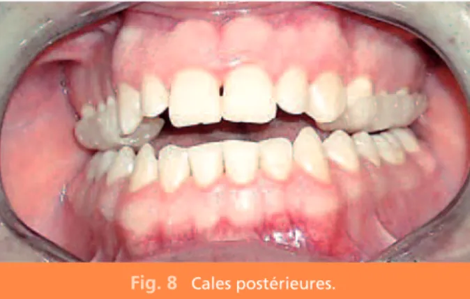 Fig. 8 Cales postérieures.