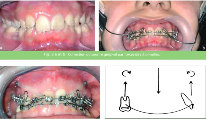 Fig. 8 a et b Correction du sourire gingival par forces directionnelles.
