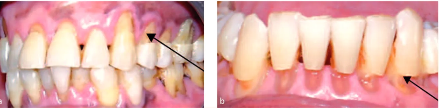 Fig. 1 a et b Lésions cervicales non carieuses au maxillaire (a) et à la mandibule (b) avant restauration.