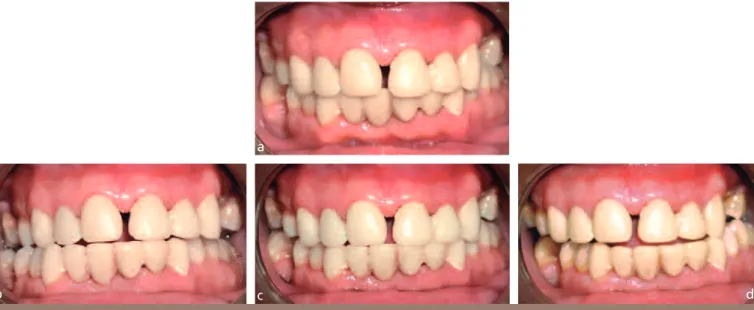 Fig. 4 a à d Réglage et validation des provisoires en bouche : a : en OIM ; b : latéralité droite; c : propulsion ; d : latéralité gauche.
