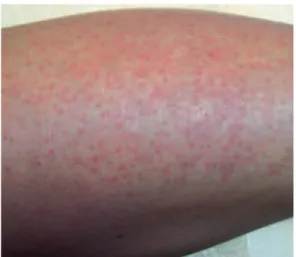 Fig. 1 Urticaire allergique de la jambe suite à la prise de pénicilline.