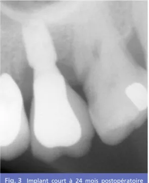 Fig. 4 Implant  Astra  Tech ® de  6  mm  de  lon- lon-gueur sur son « driver » avant sa mise en place.