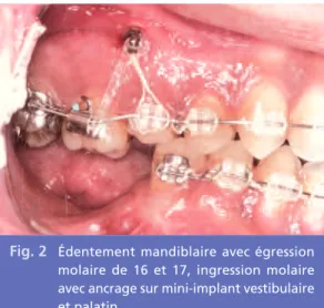 Fig. 3 Mise en place de deux implants mandibu- mandibu-laires après greffe osseuse d’augmentation verticale.