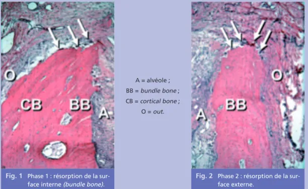 Fig. 1 Phase 1 : résorption de la sur- sur-face interne (bundle bone).