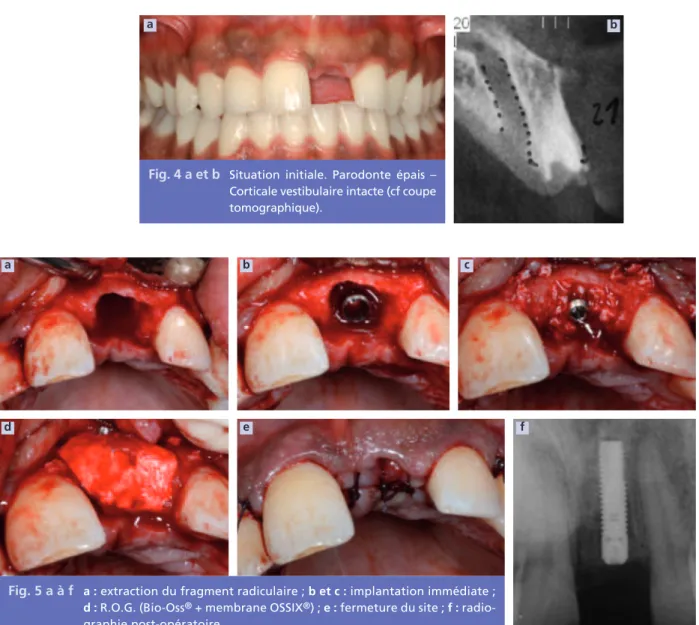 Fig. 4 a et b Situation  initiale.  Parodonte  épais  – Corticale vestibulaire intacte (cf coupe tomographique).