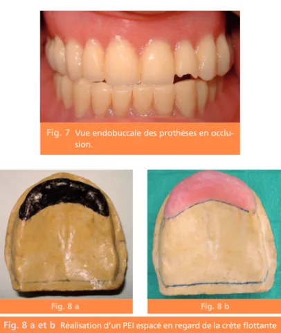 Fig. 7 Vue endobuccale des prothèses en occlu- occlu-sion.