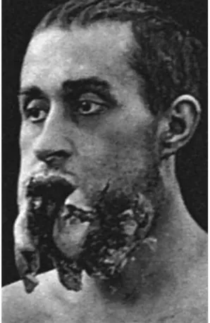 Fig. 1 Exemple de lésion maxillo-faciale [3].