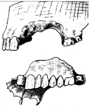 Fig. 11 Prothèse obturatrice [5].