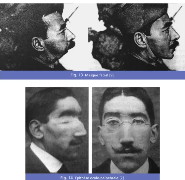 Fig. 13 Masque facial [9].