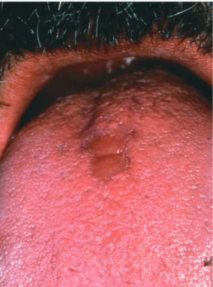 Fig. 6 Glossite losangique médiane.