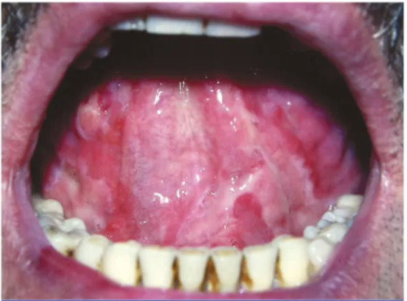 Fig. 11 Pemphigus.