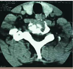 Fig. 3 (TDM en coupe axiale) Ostéolyse de la 7 e vertèbre cervicale en rapport avec une 2 e localisation du plasmocytome.