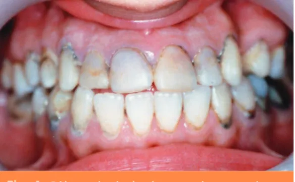 Fig. 4 Pâleur gingivale chez une jeune patiente évoquant une anémie.