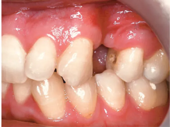 Fig. 5 La longueur de l’édentement coïncide avec la mise en place d’une première  pré-molaire maxillaire.