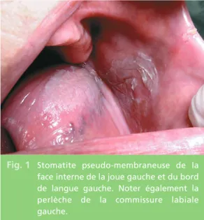 Fig. 2 Glossite atrophique avec dépapillation de la langue.