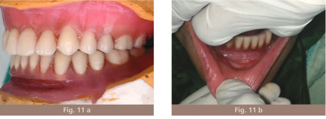 Fig. 11 a Fig. 11 b Fig. 11 a et b Montage en cire respectant la bride cicatricielle.