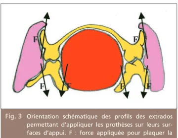 Fig. 3 Orientation schématique des profils des extrados permettant d’appliquer les prothèses sur leurs  sur-faces d’appui