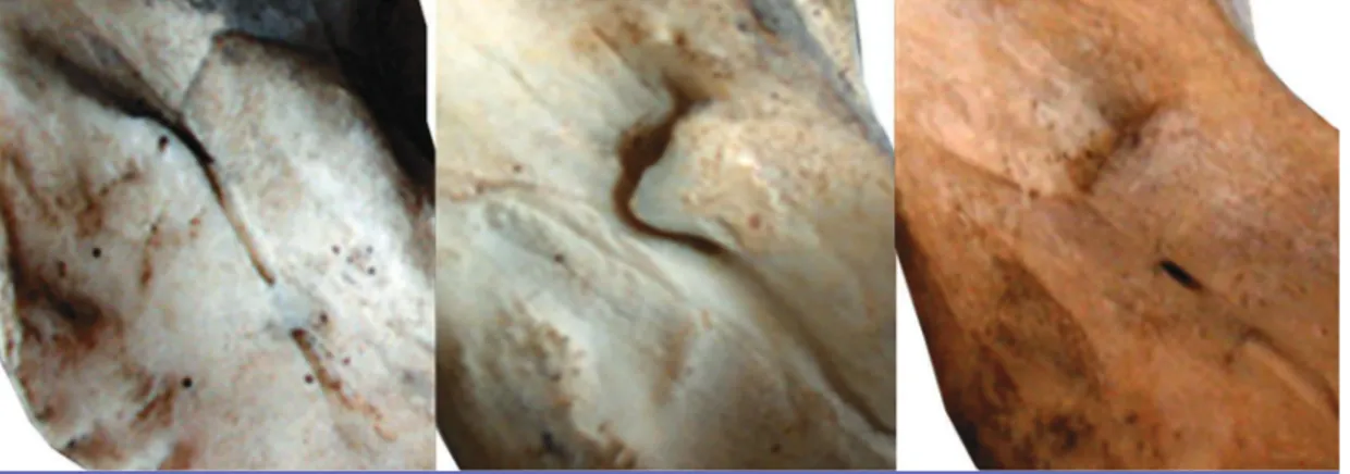 Fig. 3 a à c Aspects de l’operculation osseuse du foramen mandibulaire.