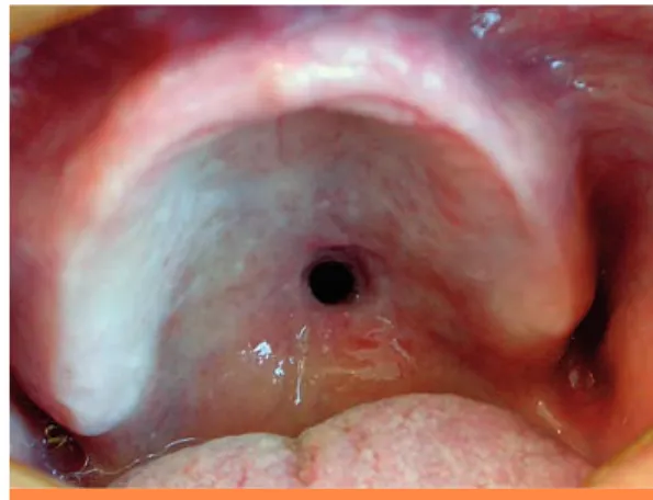 Fig. 1 Vue endobuccale de la perforation.