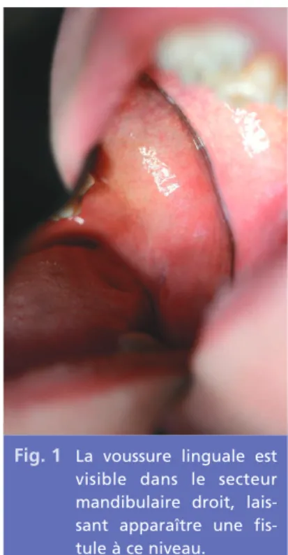 Fig. 1 La voussure linguale est visible dans le secteur mandibulaire droit,  lais-sant apparaître une  fis-tule à ce niveau.