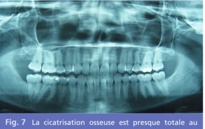 Fig. 6 La radiographie panoramique montre une lésion radioclaire volumineuse étendue de la seconde molaire mandibulaire au tiers supérieur de la branche montante mandibulaire