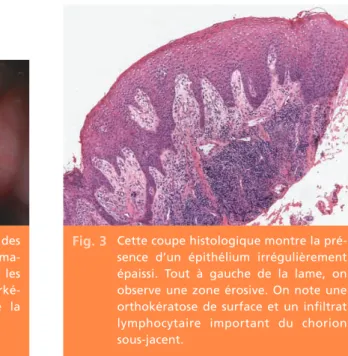 Fig. 2 Au niveau de la papille interdentaire des dents 33-34, une zone érosive  érythéma-teuse est constatée