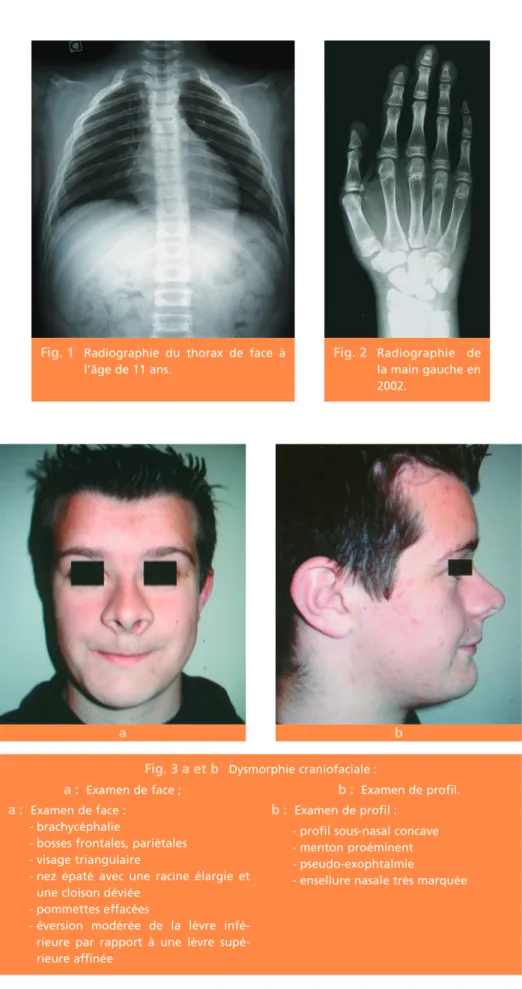 Fig. 2 Radiographie de la main gauche en 2002.