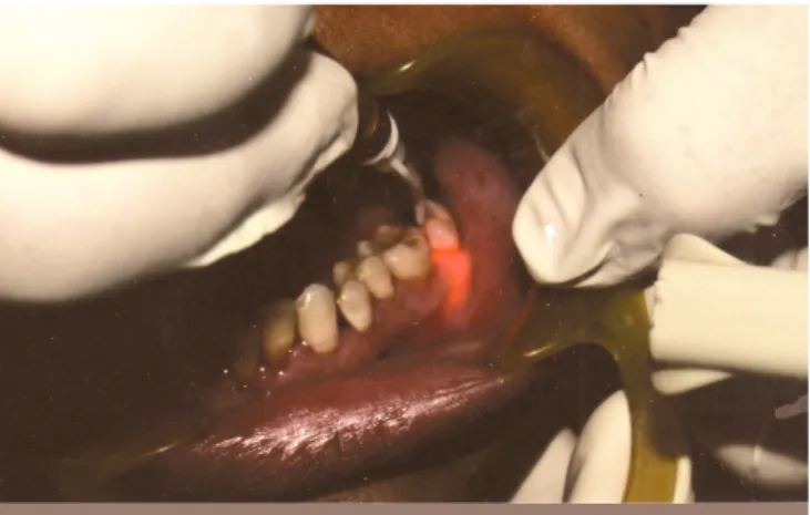 Fig. 1 Traitement de la poche parodontale. Vue opératoire, montrant la mise en place de la fibre optique du laser Nd-YAG à l’intérieur de la poche.