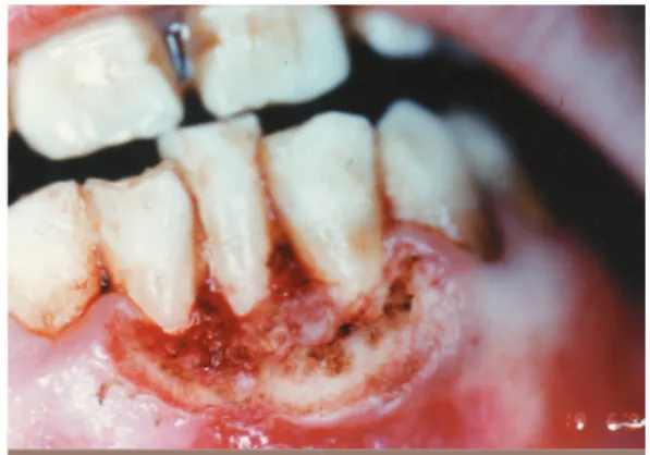 Fig. 3 a à d Excision d’épulis au laser Nd-YAG.