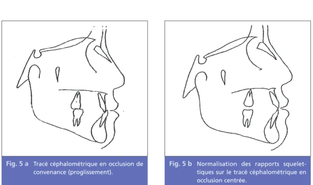 Fig. 5 b Normalisation des rapports squelet- squelet-tiques sur le tracé céphalométrique en occlusion centrée.