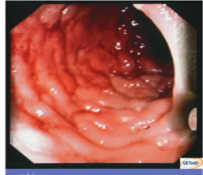 Fig. 8 a Lavement baryté. On Observe des sténoses et des dilatations  (flè-ches). A. Oudjit et al