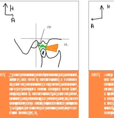 Fig. 4 Vue médiale de la région de l’articulation temporo-mandibulaire. Le muscle  ptéry-goïdien médial (PM) est tendu entre la fosse inter-ptérygoïdienne et la face médiale de l’angle mandibulaire