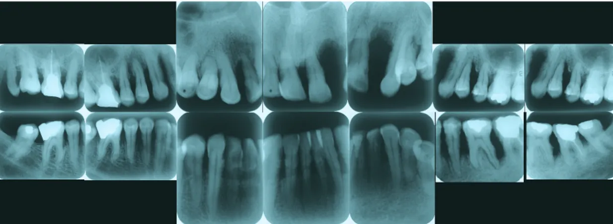 Fig. 4 Vue endo-buccale un an après une théra- théra-peutique parodontale montrant la  dimi-nution de l’inflammation.