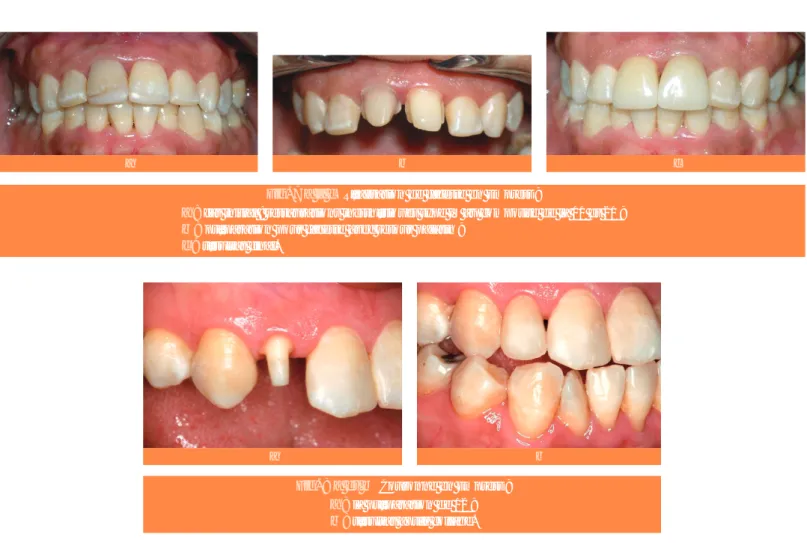 Fig. 7 a à c Réalisation de facette en Empress ;