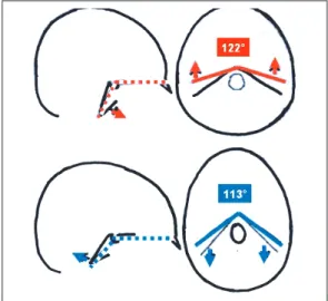 Fig. 2 Angle sphénoïdal pour les classes II et III d’après Delaire[1].