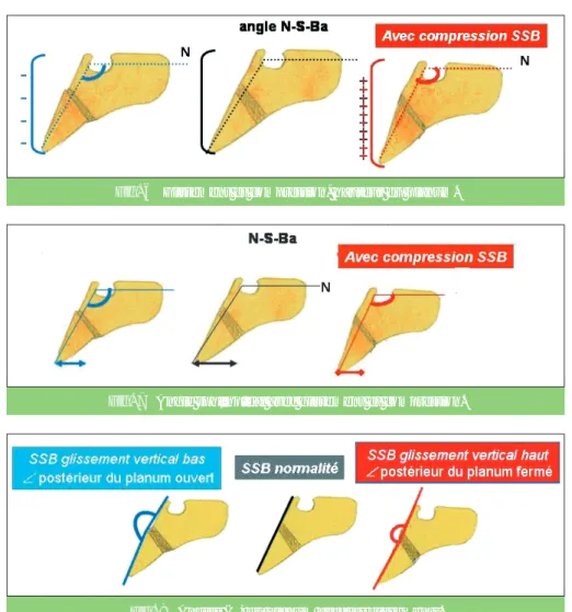 Fig. 7 Angle sphénoïdal avec glissement et compression.