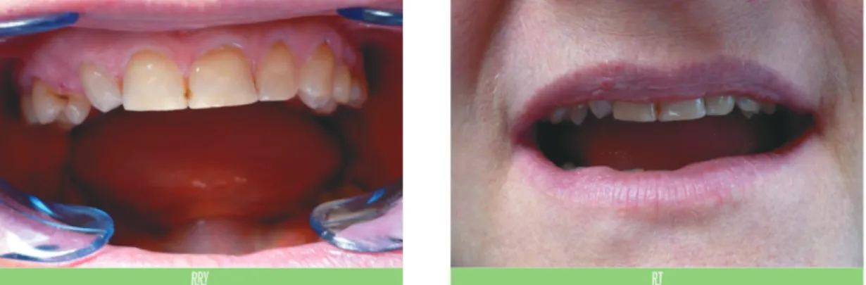 Fig. 1 c Prothèse amovible à châssis métallique.